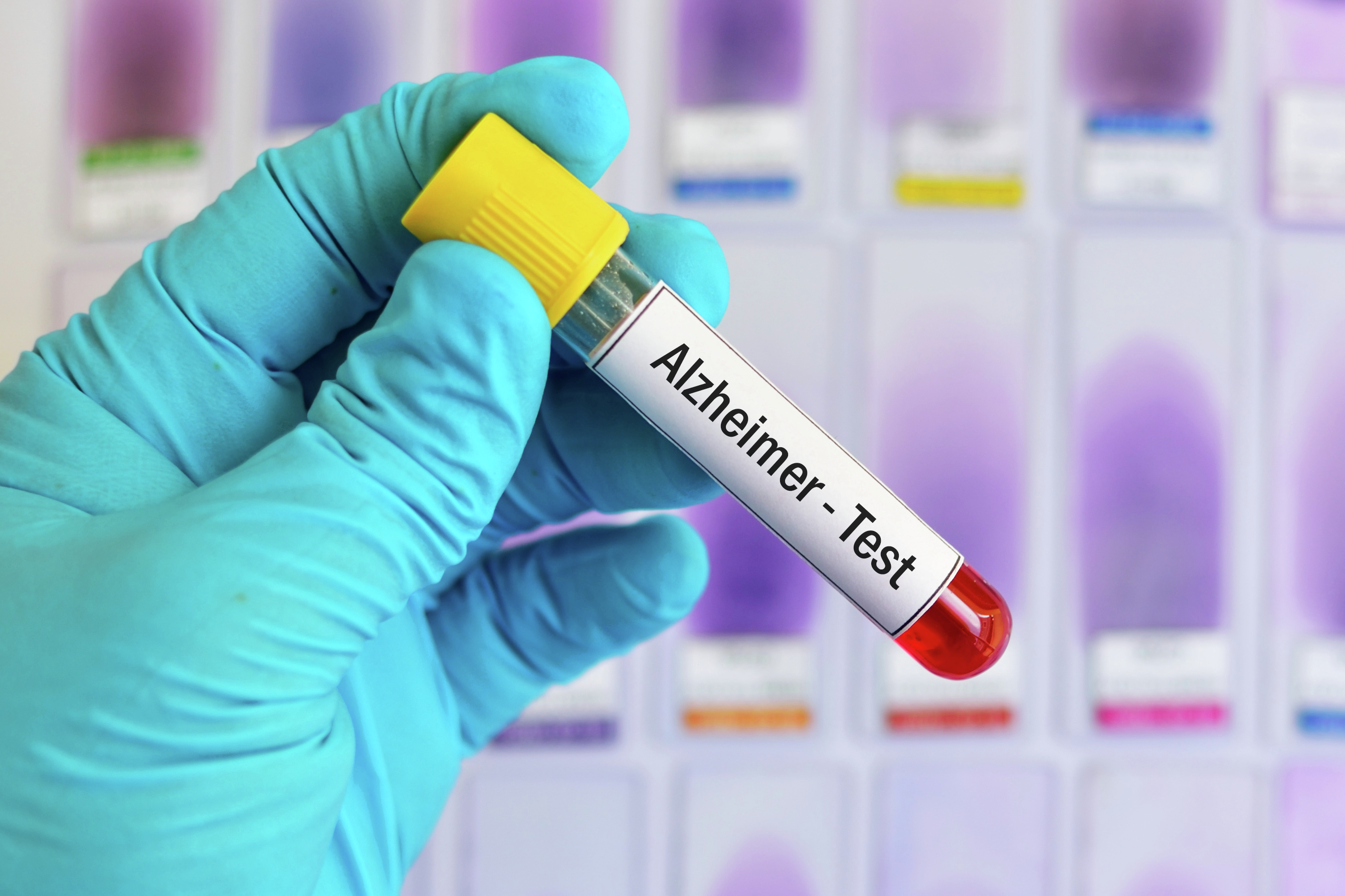 NEWSLINE: Blood test shows promise in catching Alzheimer's disease