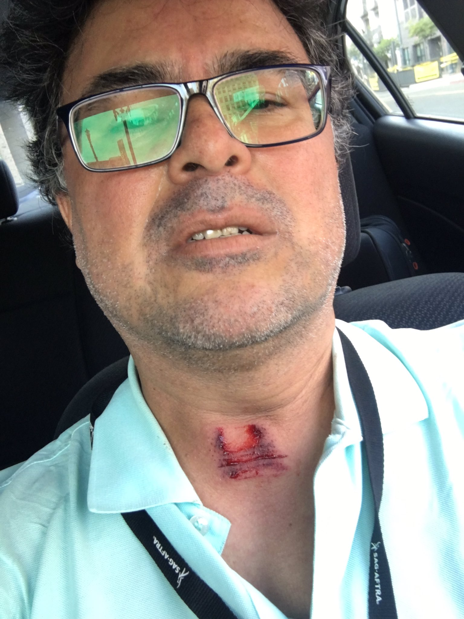 KPCC/LAist's Adolfo Guzman-Lopez Talks About Getting Shot In The Throat  With Rubber Bullet